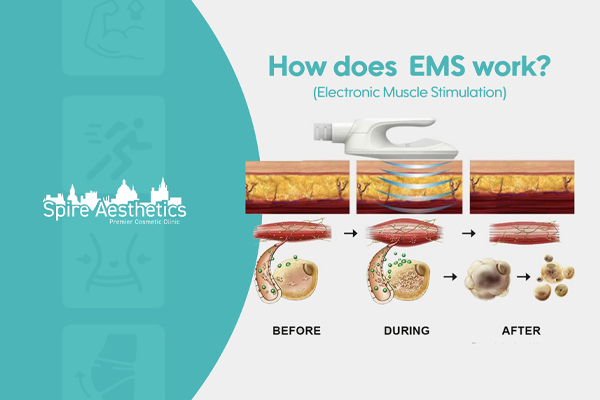 EMS treatment for post pregnancy weight loss treatment Lichfield