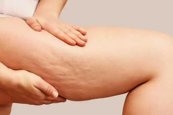 Image of woman showing leg with cellulite Lichfield