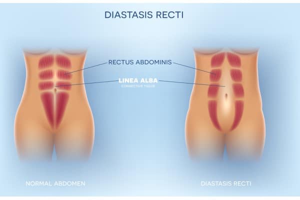 What Non-Surgical Options Are Available for Diastasis Recti Lichfield?