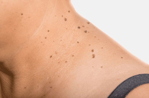 Are you looking for easy skin tag removal Lichfield - then contact Spire today!