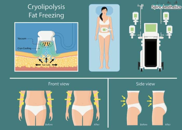 Image of diet and fat freezing combined for best results for Spire Aesthetics Lichfield