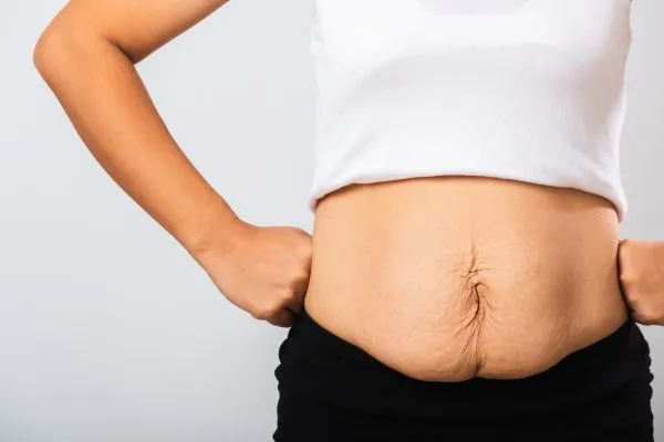 Image of a woman's stomach after weight loss with sagging skin following a gastric band Lichfield