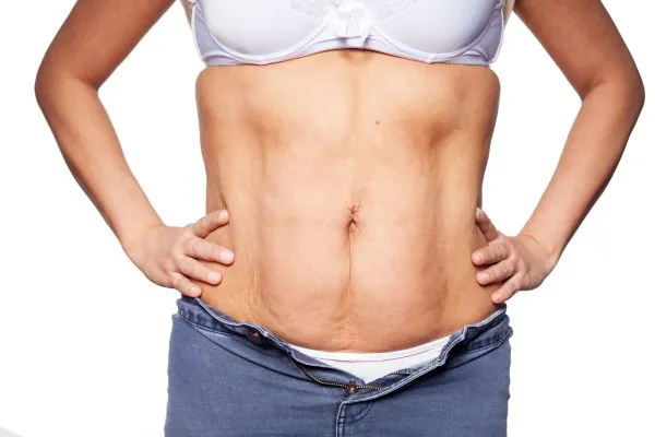 sagging skin on woman's stomach after weight loss injections Lichfield