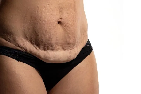 Image of womans stomach after weight loss injections Lichfield showing saggy skin