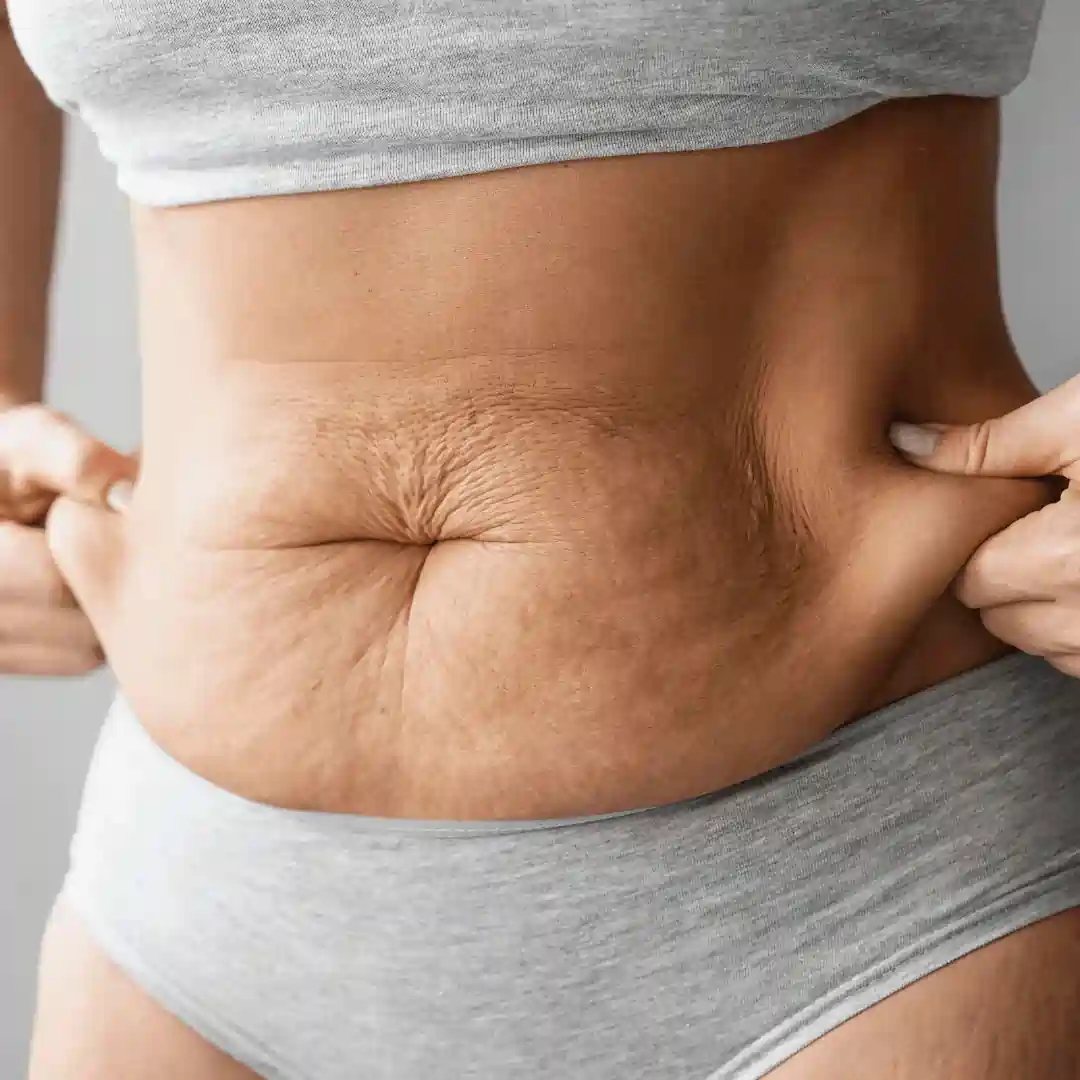 Is It Normal to Have Loose Skin After Pregnancy Lichfield?