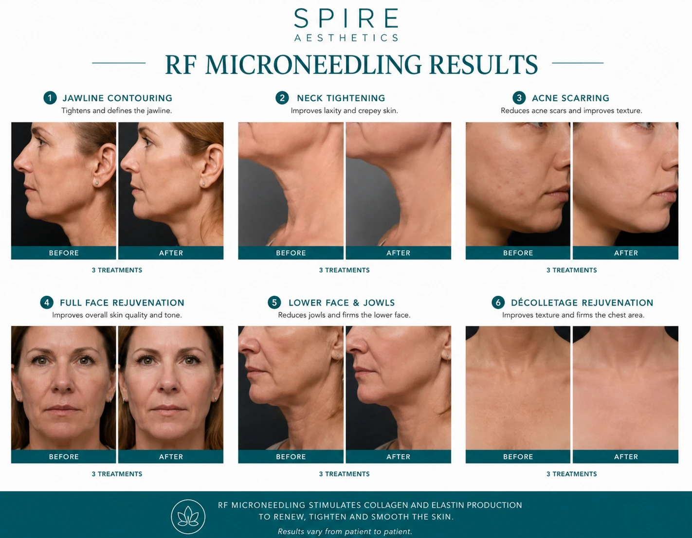 RF Microneedling Skin tightening Lichfield results
