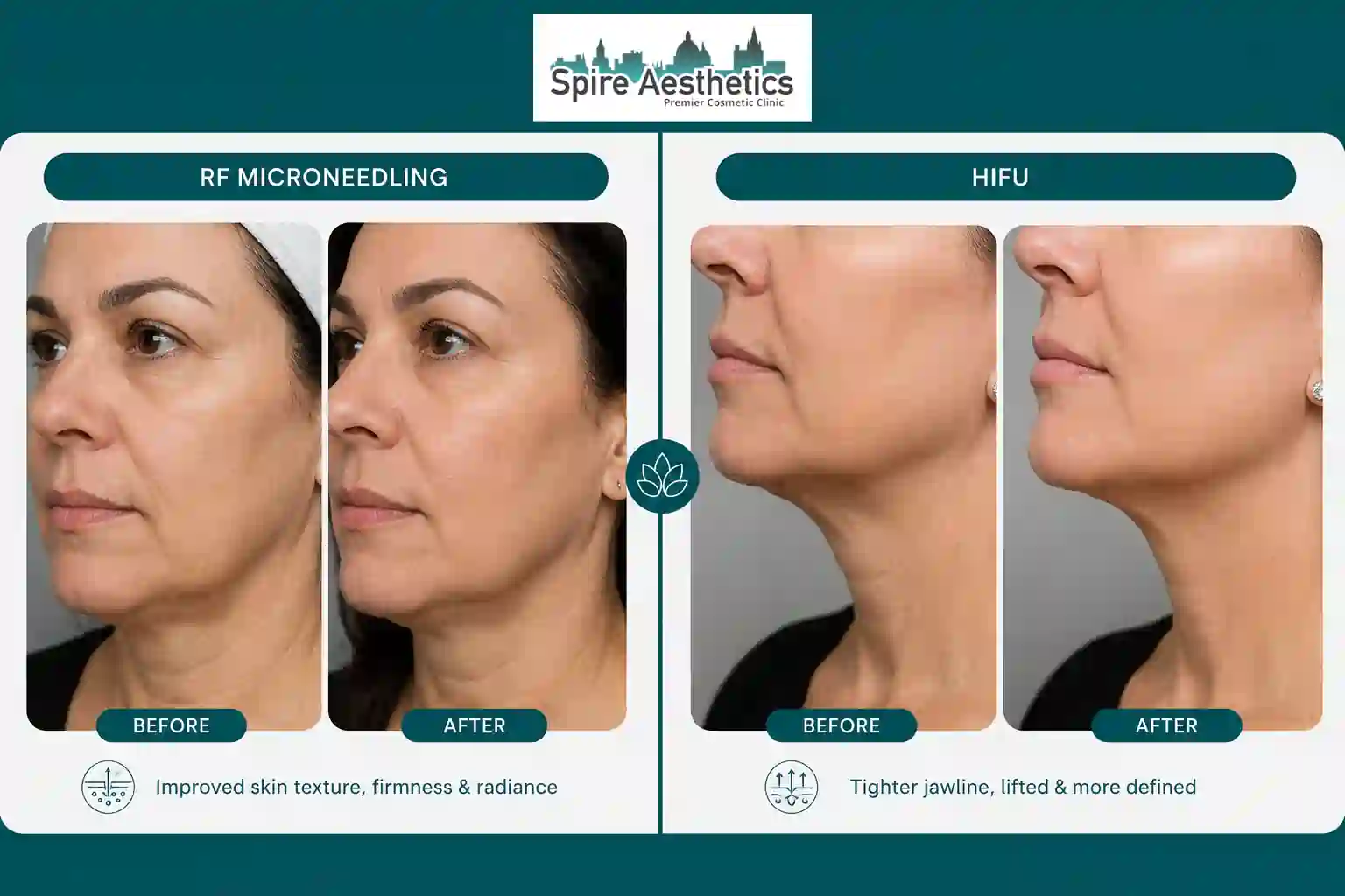 Can RF Microneedling and HIFU Be Combined Lichfield?