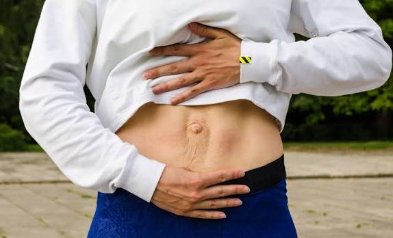 When Could Diastasis Recti Be the Missing Piece of the Puzzle Lichfield?