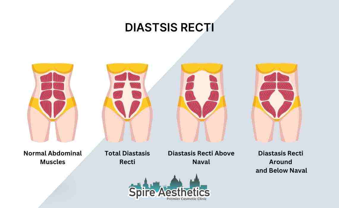 Is Non-Surgical Diastasis Recti Treatment Right for You? Common Concerns Answered Lichfield